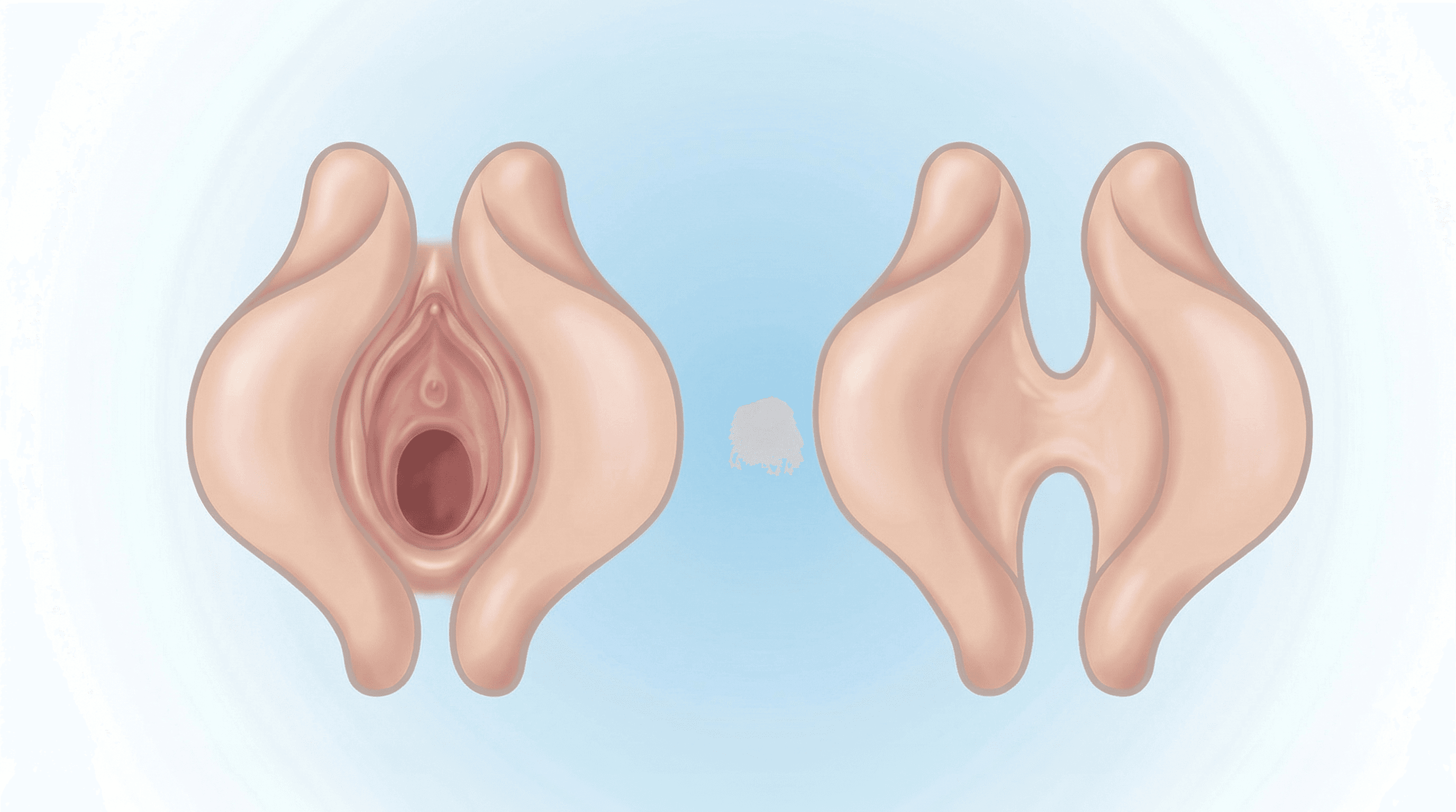 Sinequia Vulvar